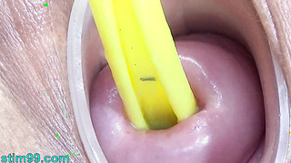 Cervix and Pee Hole Inflation with Injections for Japanese Lesbians