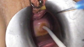 Cervix extraordinary obgyn have fun