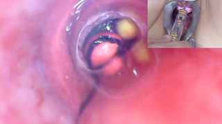 Mature Woman Peehole Endoscope Camera in Bladder with Balls