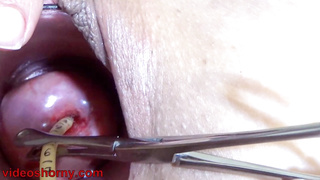 Insertion the catheter in Cervix women Mature
