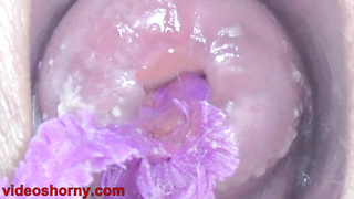 Endoscope with camera is inserted into the cervix to see inside