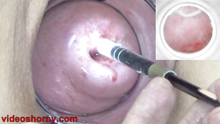 Endoscope with camera is inserted into the cervix to see inside