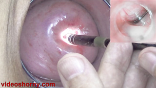 Endoscope with camera is inserted into the cervix to see inside