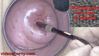 Endoscope with camera is inserted into the cervix to see inside