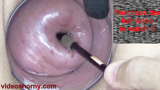 Endoscope with camera is inserted into the cervix to see inside